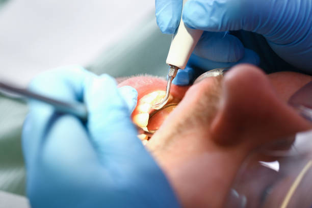 Best Emergency Wisdom Teeth Removal in Hinesville, GA